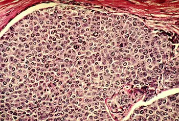 This microscope view at 100&times; magnification shows breast cancer cells invading normal tissues and establishing new centers of growth.