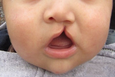 Child with cleft lip and palate