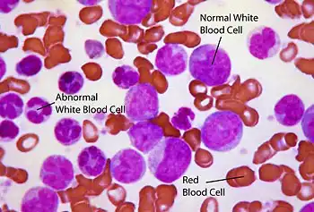 Unlocking The Secrets Of Leukemia Umass Lowell