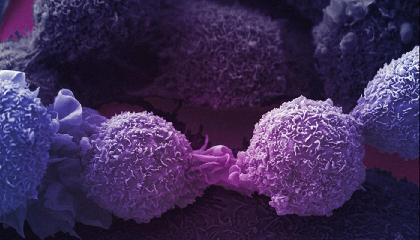 Highly magnified view of lung cancer cells