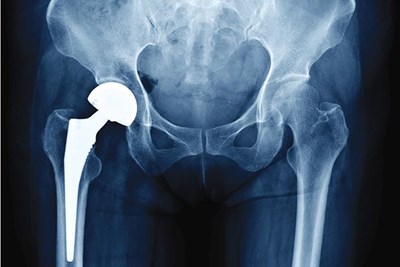 Xray of hip ball joint